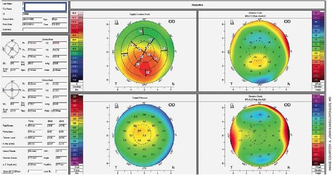 Corneal topography map showing keratoconus with characteristic steepening patterns in curvature and elevation data