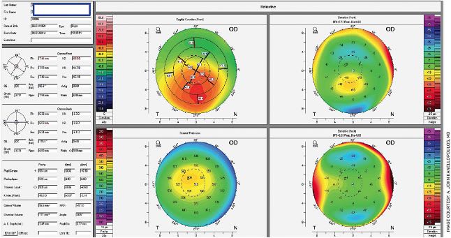 Orange County keratoconus specialist - scleral lens fitting for vision restoration